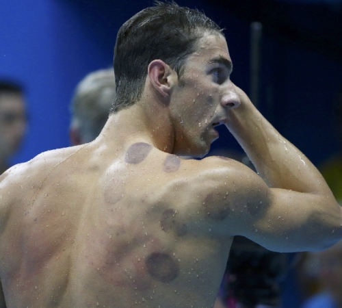 Michael Phelps Olympics Cupping