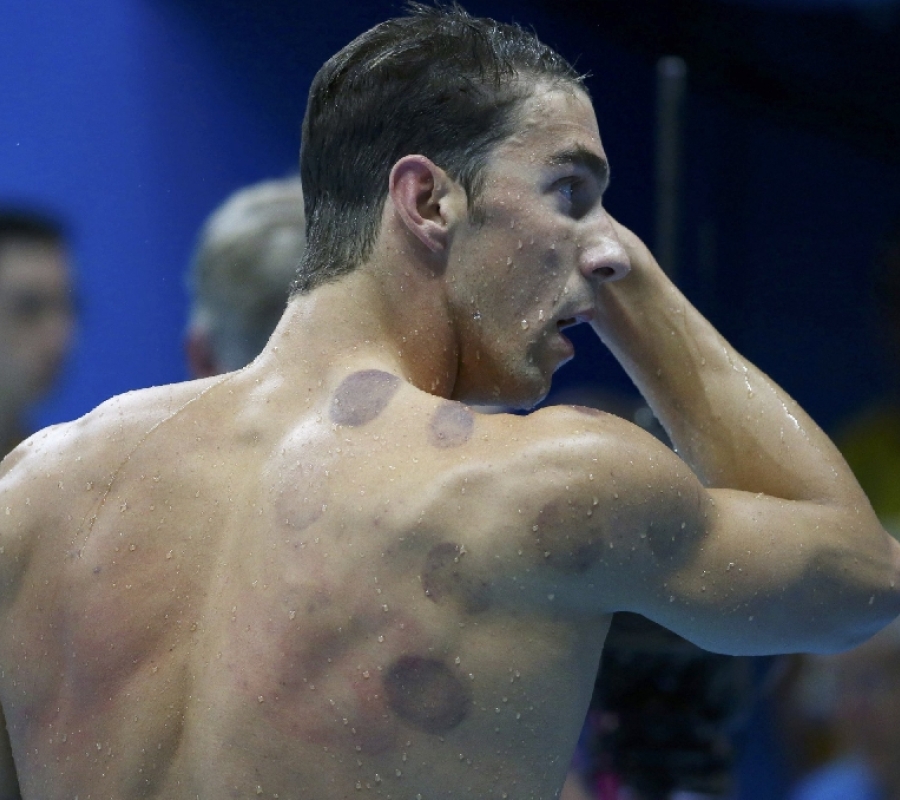 Michael Phelps Olympics Cupping